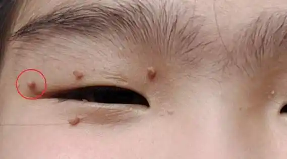 眼部温热免疫诱导疗法联合外用药治疗青少年眼部寻常疣成功案例