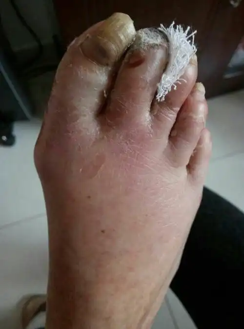 足部逐渐坏疽