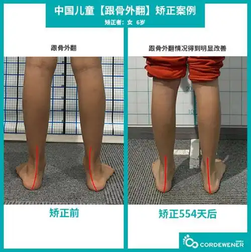 足外翻矫正案例