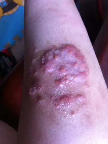 左脚小腿左侧湿疹如图,已经烂了三四年了,现在哺乳期,用地奈得药膏擦