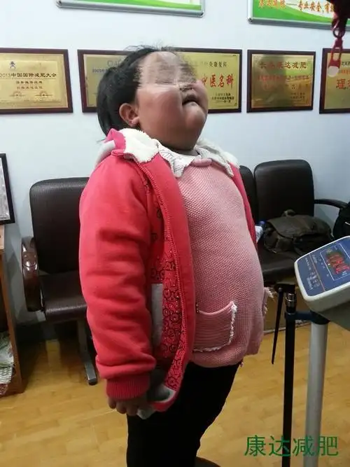 国际儿童日康达减肥关注儿童肥胖