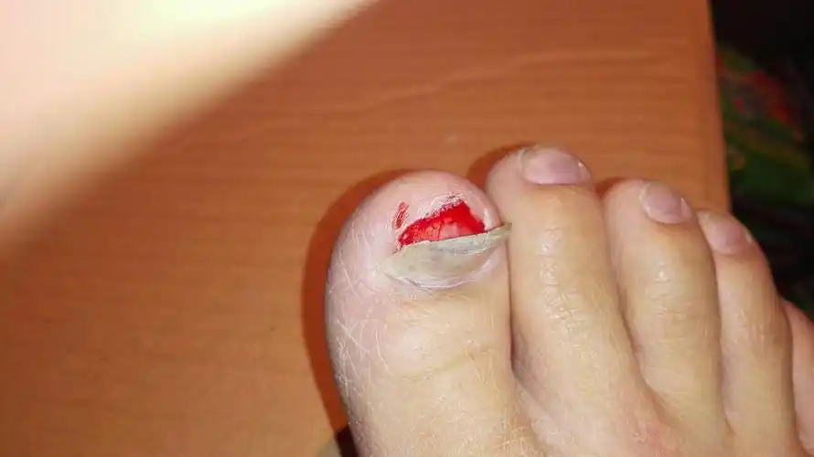 指甲盖反了,咋办啊