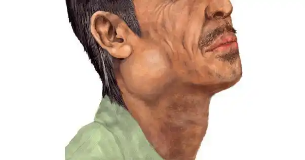 淋巴瘤最会伪装,如身体反复出现这3个症状,需高度警惕!