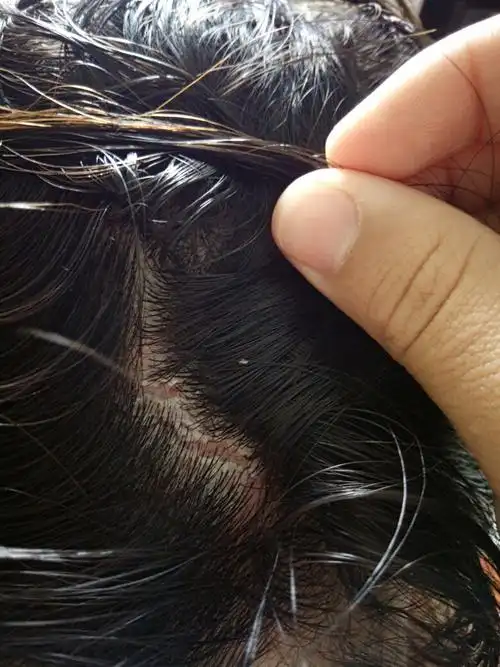 头皮结疤,头皮上面有白色的疤控制不住挠过很多次,挠过后头皮会分泌出