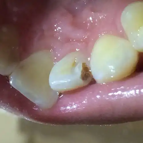 这颗牙在做过一次光固化之后材料掉了一直没补结果今天牙齿掉了一块.