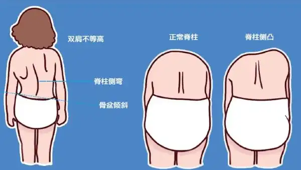 而且脊柱侧弯的手术难度大,费用高昂,对身体的损伤也大,非必要是不