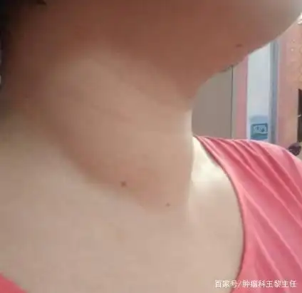 乏力食欲不振颈部肿大看中医如何治疗