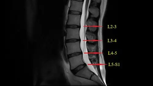 腰椎1-l1关联部位:大肠 结肠,腹股沟容易引起的症状:便秘 腹泻 结肠炎