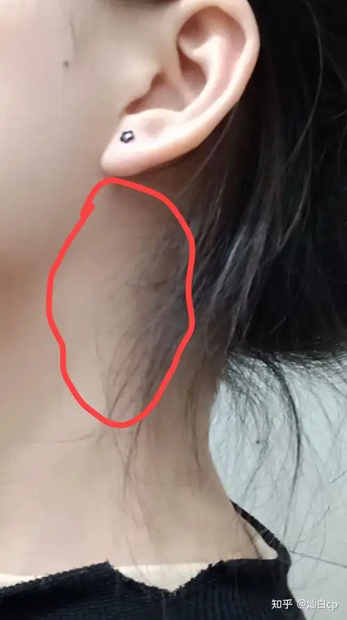 脖子突然很疼是怎么回事