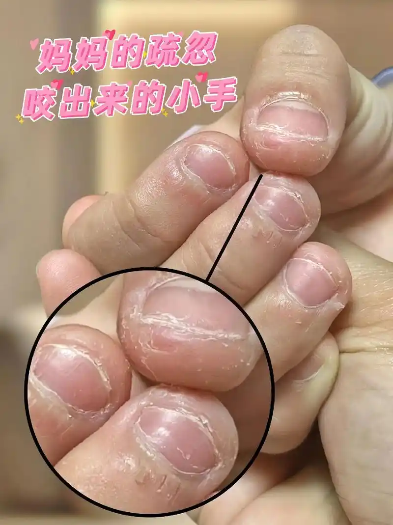 我的宝宝太爱吃手指了!终于找到#葵花防护苦甲水 戒咬