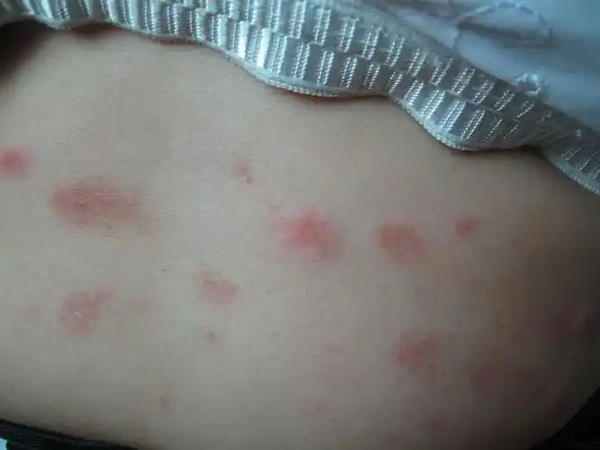 丘疹性荨麻疹