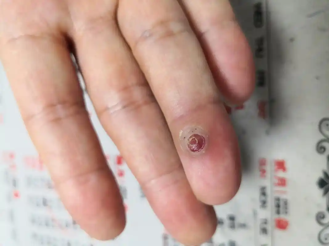 手指红色血管瘤样症状,是化脓性肉芽肿.