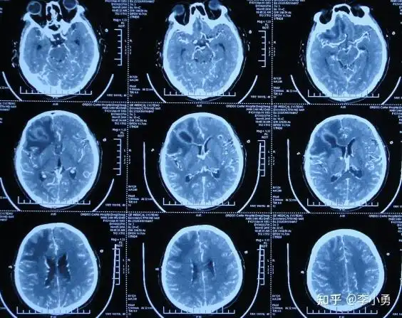 自发脑脓肿破裂性脑室内感染28天在李小勇脑脊液科治后变完好