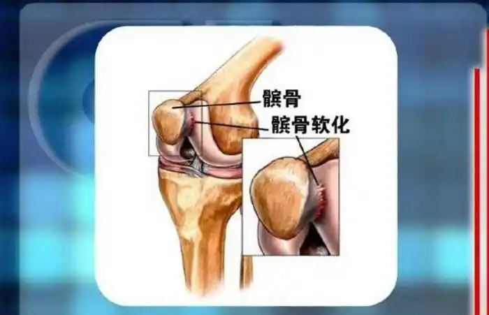 髌骨软化症的病因是什么?有哪些临床症状呢?