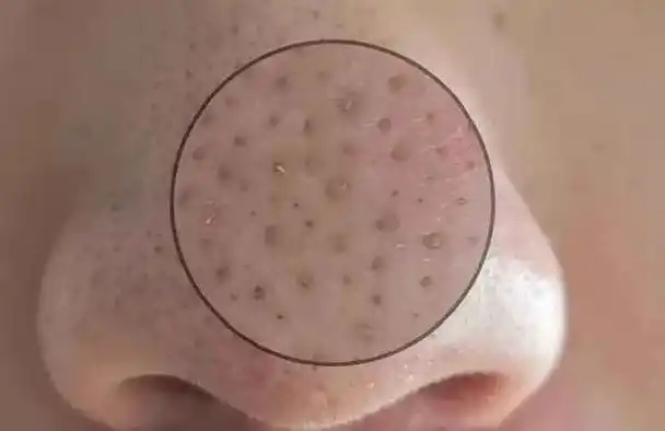 20倍放大可视化黑头仪能吸出成超多的油脂爽