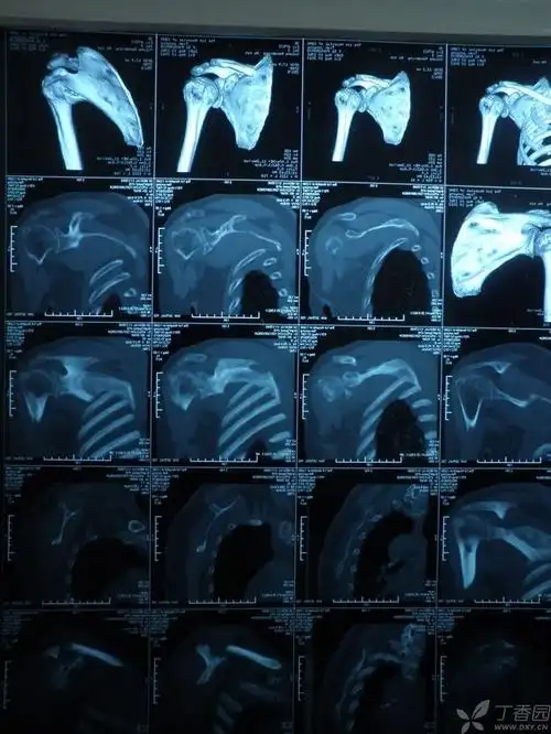 肩胛盂骨折,肩袖损伤是否需要手术?