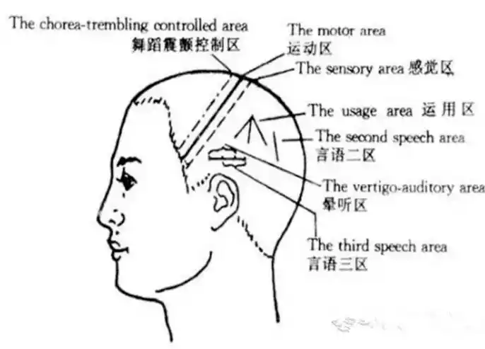 三千青丝中掩藏的秘密焦氏头针