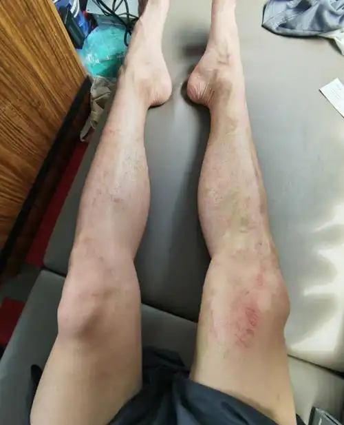 作为一个帅气男演员,皮肤受伤这么严重,估计很难不影响到工作.