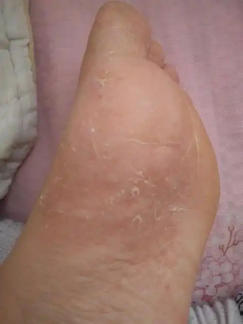 脚好痒,还有小子子!还脱皮!怎么办?