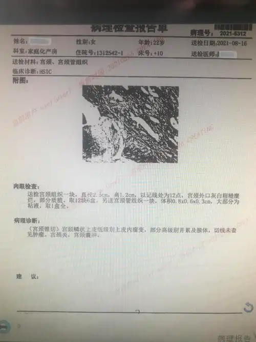 高级别鳞状上皮内病变(hsil)宫颈锥形切除术精选