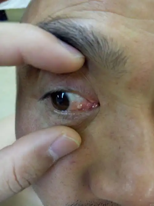 求助,右眼球结膜白色圆异物,不痛不痒,视力正常