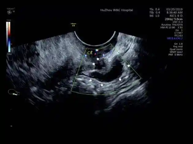 肠道子宫内膜异位症的超声诊断_病变_肠壁_检查