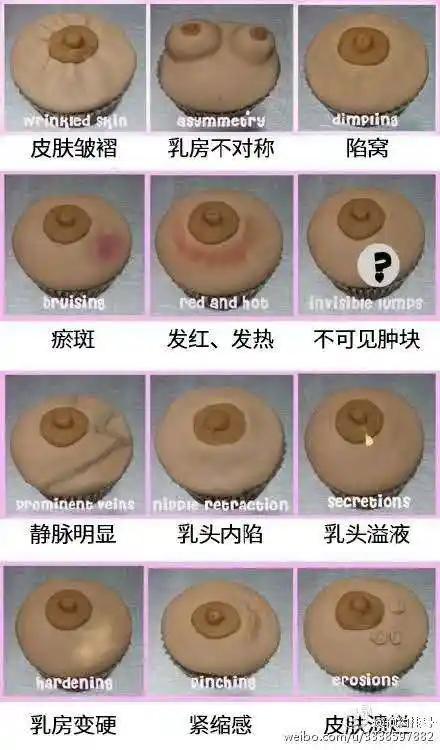 乳腺癌的临床表现图解