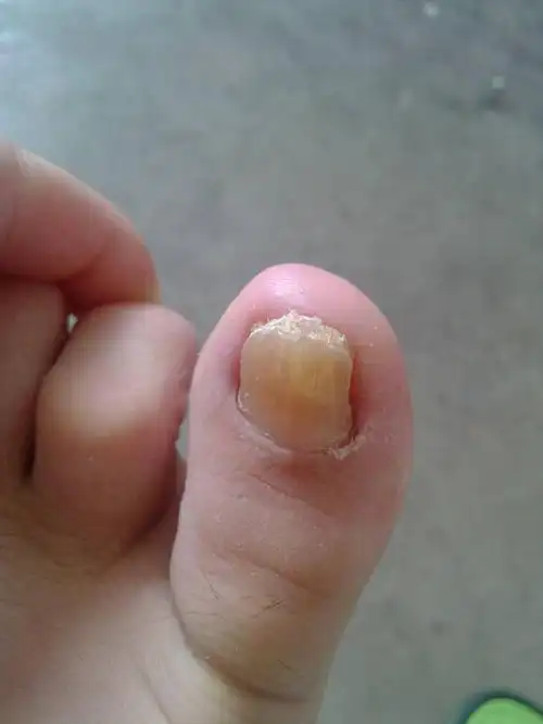 剪指甲发黄 变得特别厚 用手一按还特别疼啊 什么情况啊?