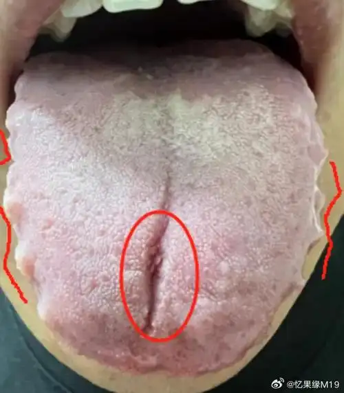 岁女患者的舌象,看上去有点瘆人,问题也是比较明显,舌质淡白,舌苔白腻