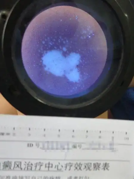 不恰当治疗引起白癜风的扩展