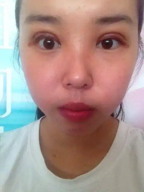 全切双眼皮,做的是扇形的8mm,术后有十一天了