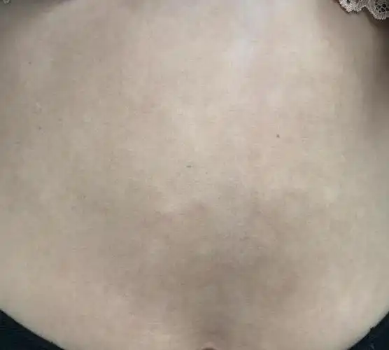 女孩肚子很多白斑一直当汗斑治疗没有任何效果