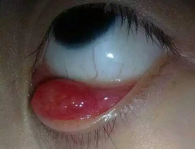 麦粒肿,中医叫"针眼",症见胞睑生小疖肿,形似麦粒,易于溃疡.