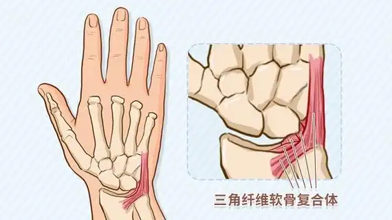 三角纤维软骨复合体核心是一个软骨盘,周围有一圈韧带,像一个吊床一样