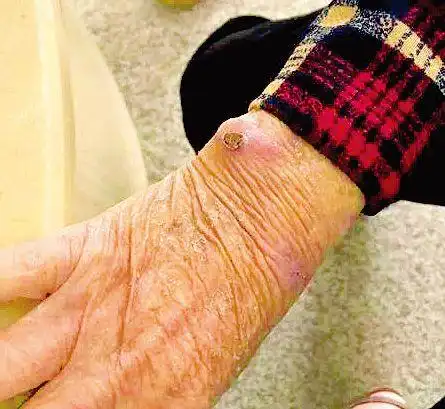 吓人惠东阿婆被恙虫咬了一口高烧4天你身边也有或危及生命