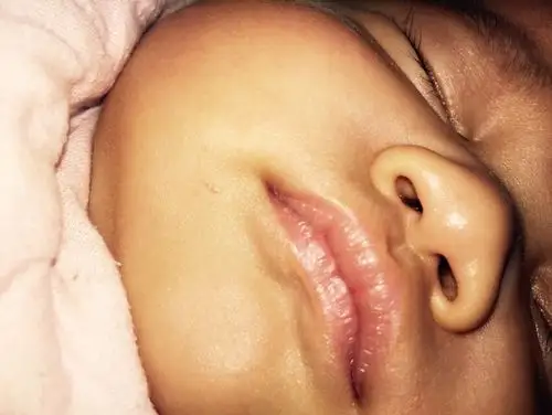 我家宝宝鼻孔两边好像多出两块肉,这样是正常的吗