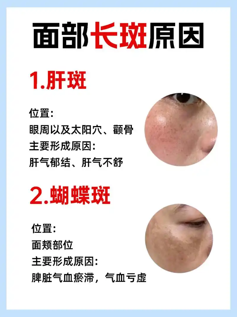 肝斑 位置: 眼周以及太阳穴,圈骨 主要形成原因: 肝气郁结,肝气不舒