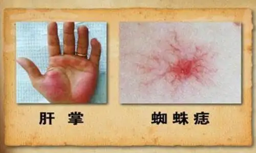 武汉看肝病厉害的专家老中医向贤德教授肝不好乙肝大三阳有什么症状