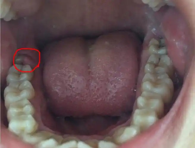 昨天刚发现靠后面的下排牙齿牙龈部位的牙肉突出了,请问该怎么处理呢