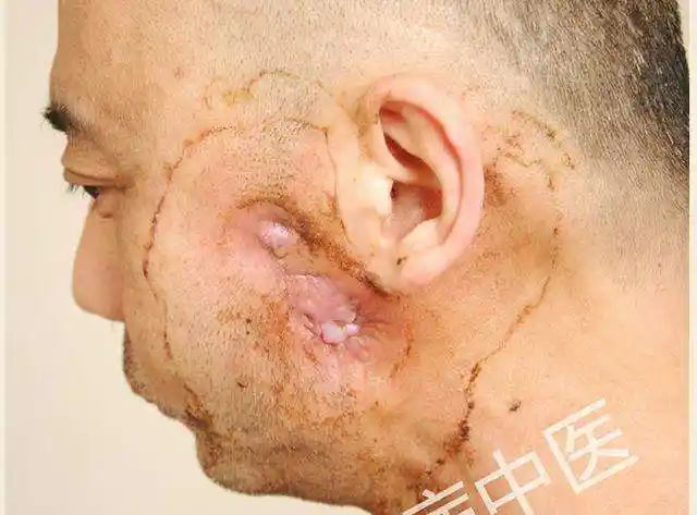 过量喝酒竟也会引起骨髓炎转给更多爱喝酒的人看看