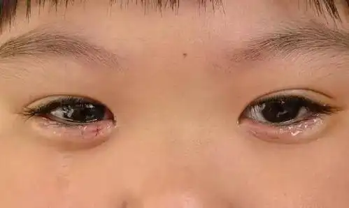 倒睫毛对眼睛的危害大吗