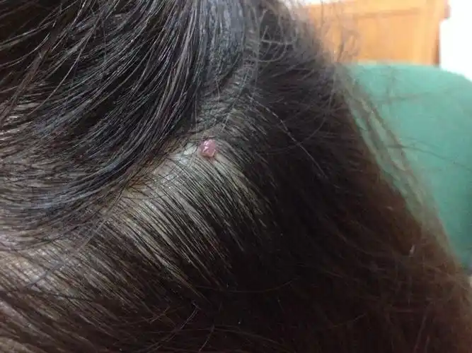 头皮上长这个是什么东西?