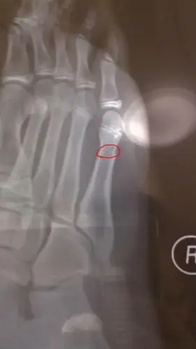 这些都是骨折第二天拍的片子