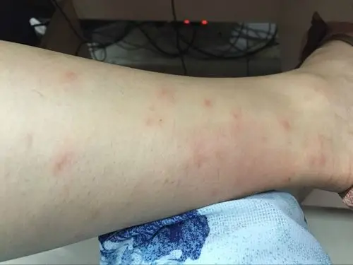 是湿气重还是过敏?