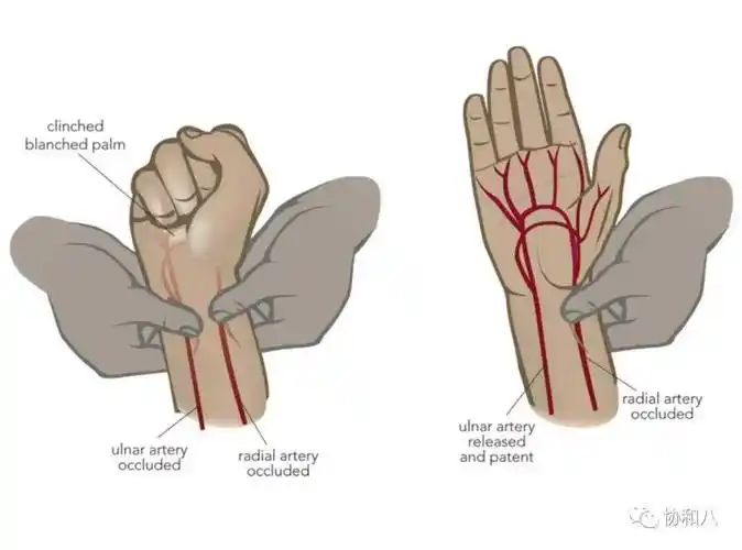 关于动脉血气采集与各项指标的意义_患者_桡动脉_血液