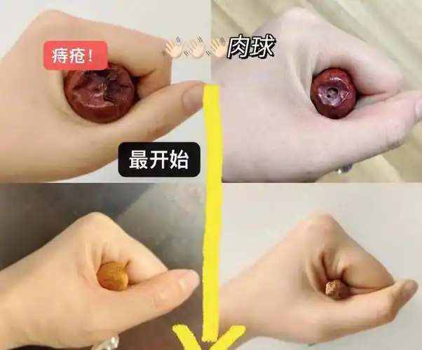 痔疮术后复发怎么应对经验人士推荐有效去痔产品肉球迅速消失