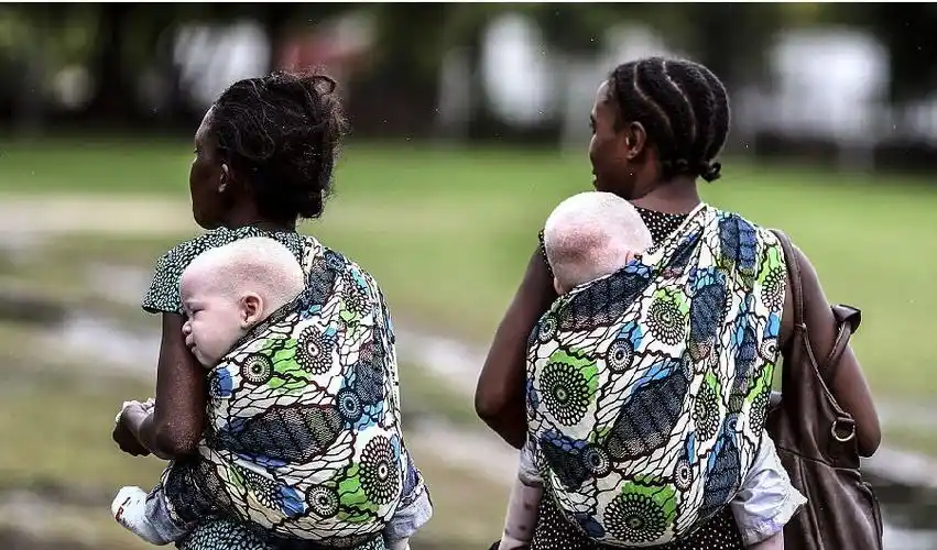 非洲现大量白化人,科学证实白种人起源非洲人得印证