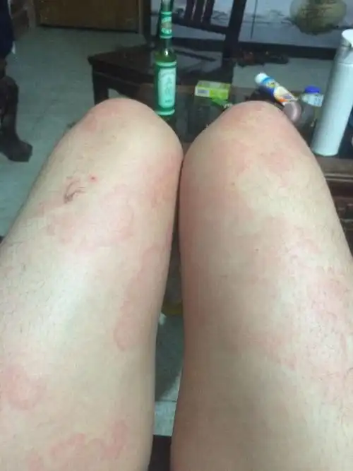 热血风团寻麻疹,有没有经历过治好的分享下经验.