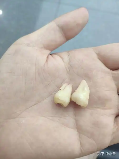 智齿长得很好(即正位不痛)是什么体验? - 知乎