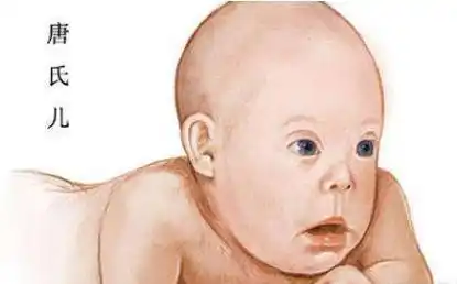 这种疾病关乎你肚子里宝宝的健康,快来了解什么是唐氏综合征 ▎健康